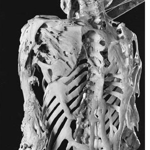 fibrodysplasia